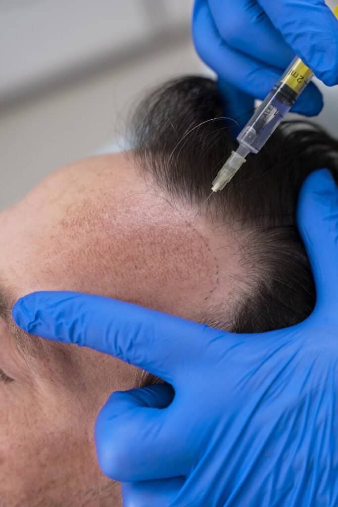 hair transplant
