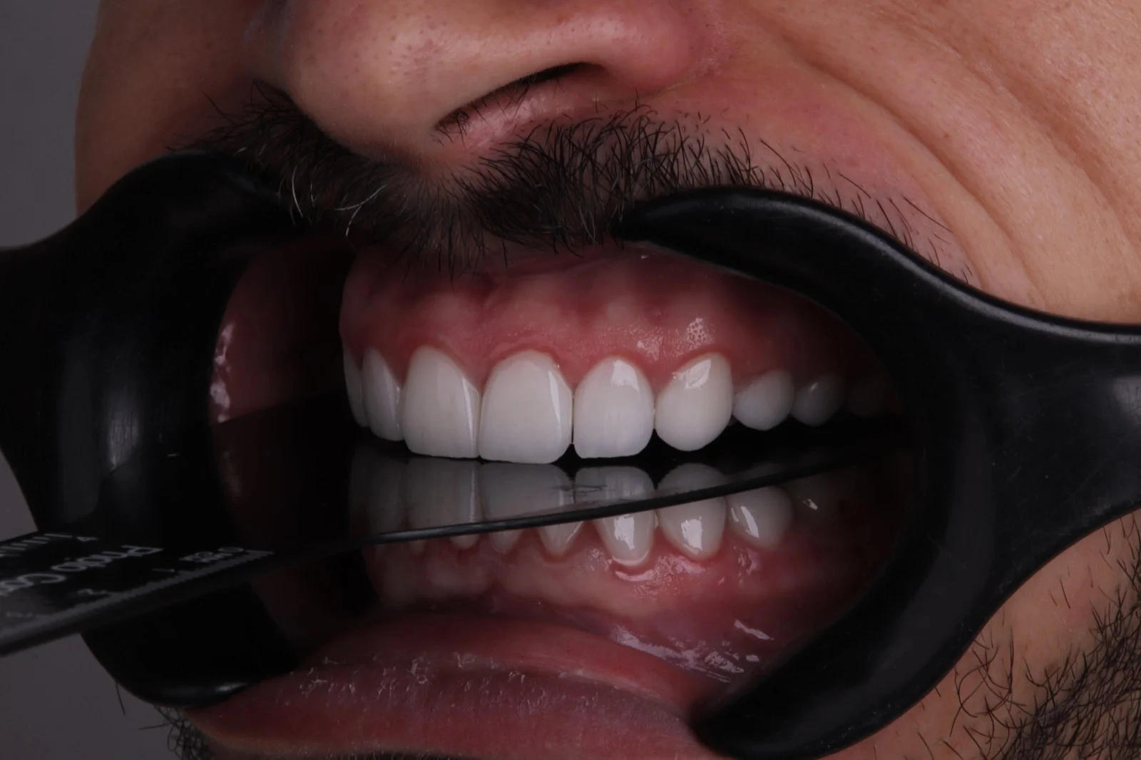 hollywood smile