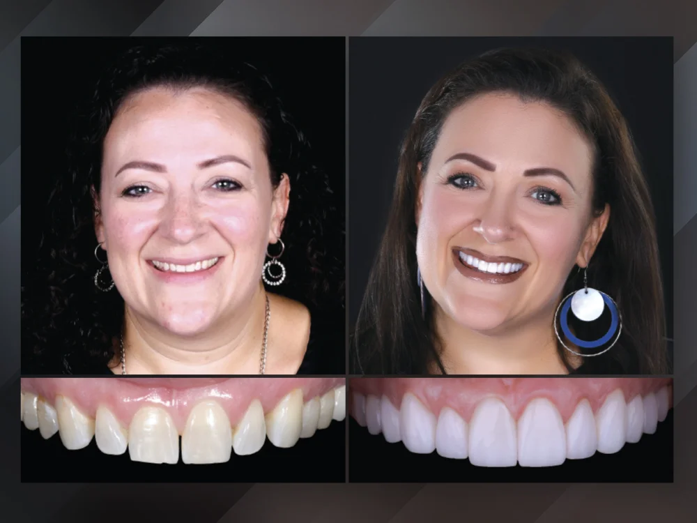 Dental Veneer