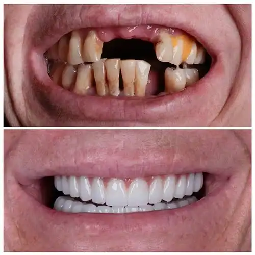 dental implant