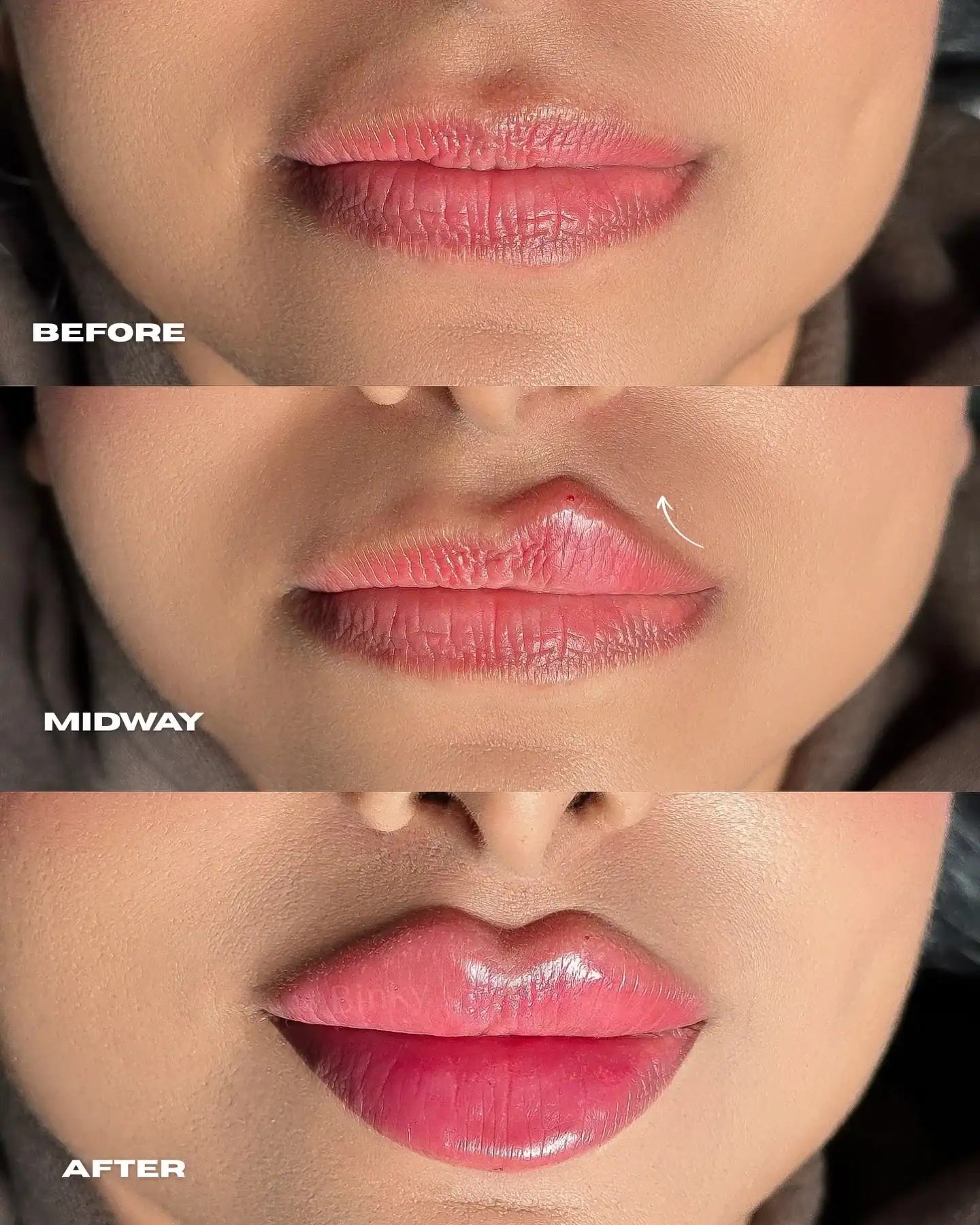Lip Filler